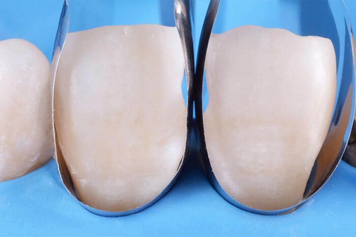 Unica anterior matrix - Image 2