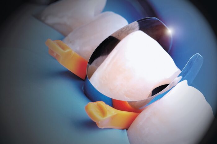 Unica anterior matrix