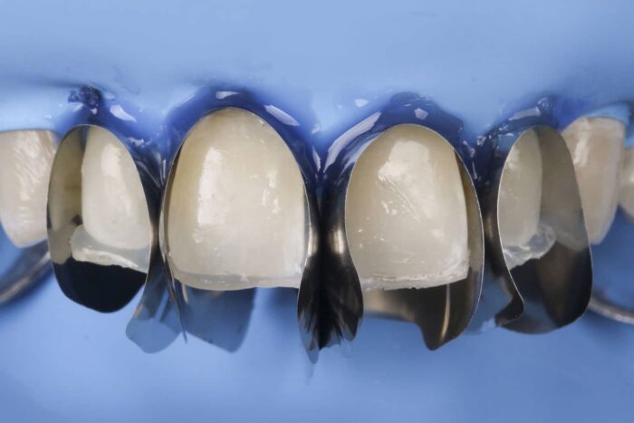 Unica minideep anterior matrix
